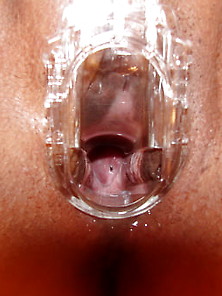 Speculum